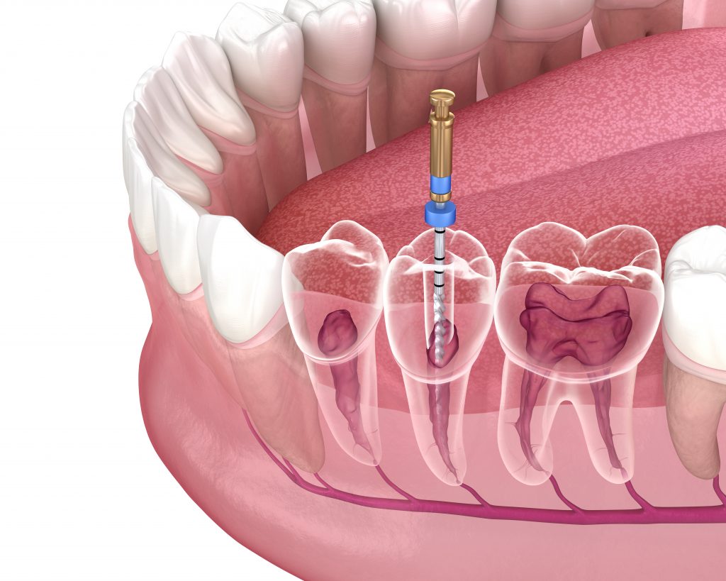 Language : EnglishTopics: Root canal infectionTooth pain is one of the most common health problems i...