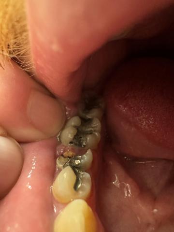 Image: Severity: CriticalTeeth Problems: Damaged fillingTooth decayTeeth Case Analysis (Based on Pho...
