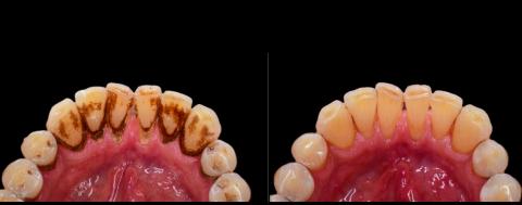 Image: Severity: SevereTeeth Problems: Gum infectionA patient presented with extreme tartar buildup,...