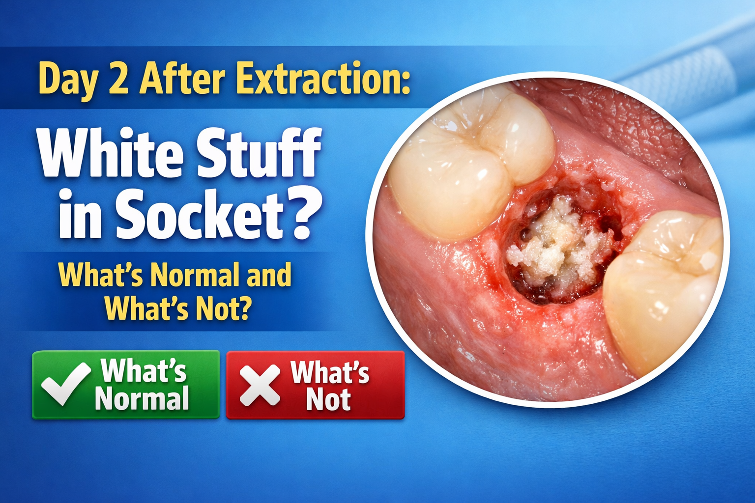 Language : EnglishTopics: Dry socket (alveolar osteitis)Socket infectionAfter a tooth extraction, ma...