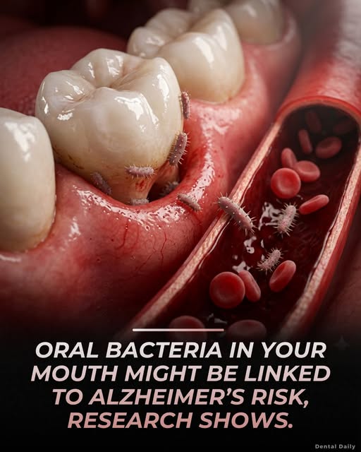 Language : EnglishTopics: Bacterial buildupTeeth conditionResearchers have discovered that Porphyrom...