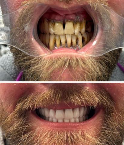 Image: Severity: ModerateTeeth Problems: Dental ImplantsGum infectionTeeth Case Analysis (Before & A...