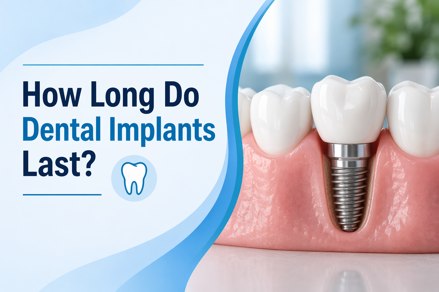 Language : EnglishTopics: Dental ImplantsDental implants are one of the most durable and long-lastin...
