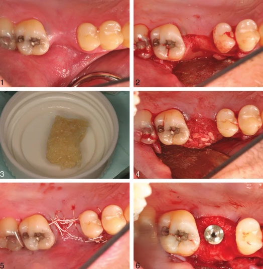 Language : EnglishTopics: Bone graftExtractionAfter a tooth extraction, many patients ask: “Do I nee...