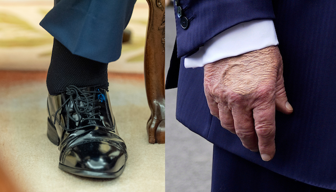 Medical report says Trump remains in excellent health, with minor leg swelling and bruising showing...