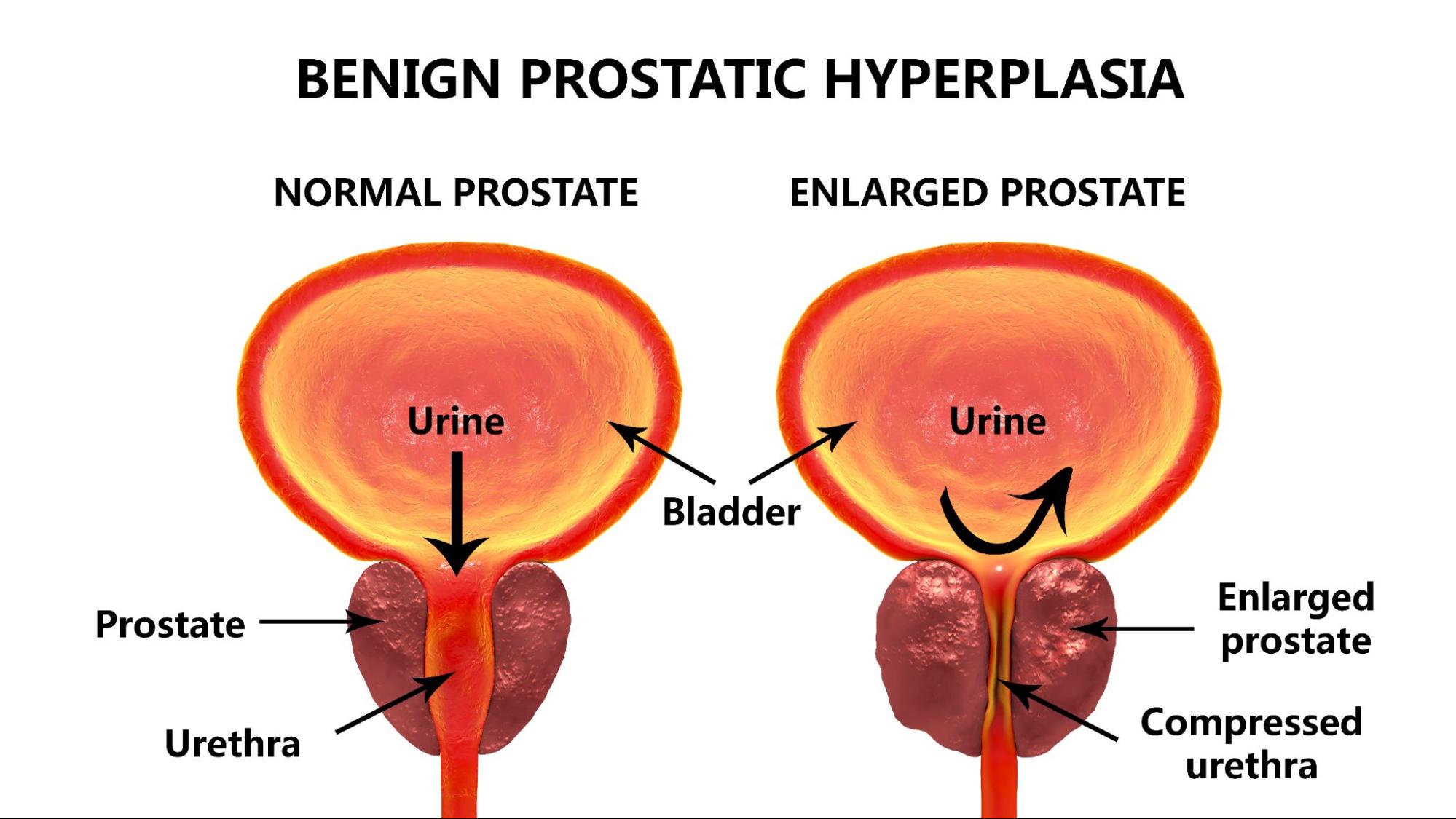 It is critical to distinguish between the symptoms of prostate cancer and benign prostatic hyperplas...
