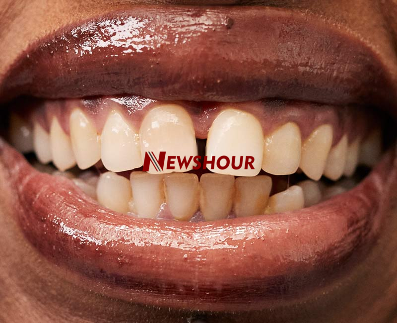 Many people casually refer to the space between the front teeth as “gap teeth” or “open teeth.” Whil...