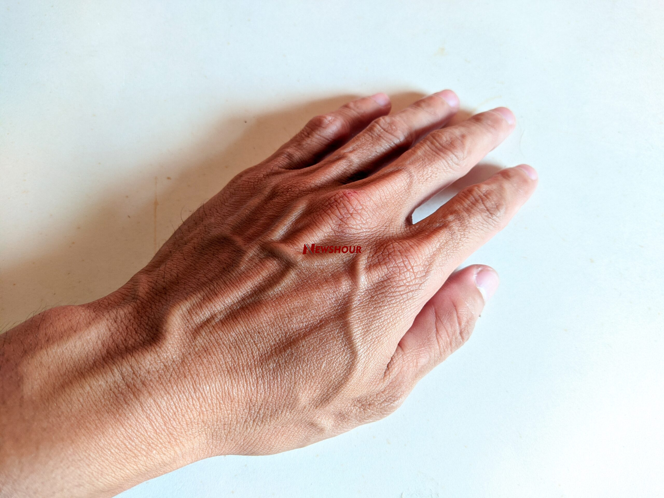 Veins are present on every human being. It’s impossible to have adequate nutritional and blood circu...