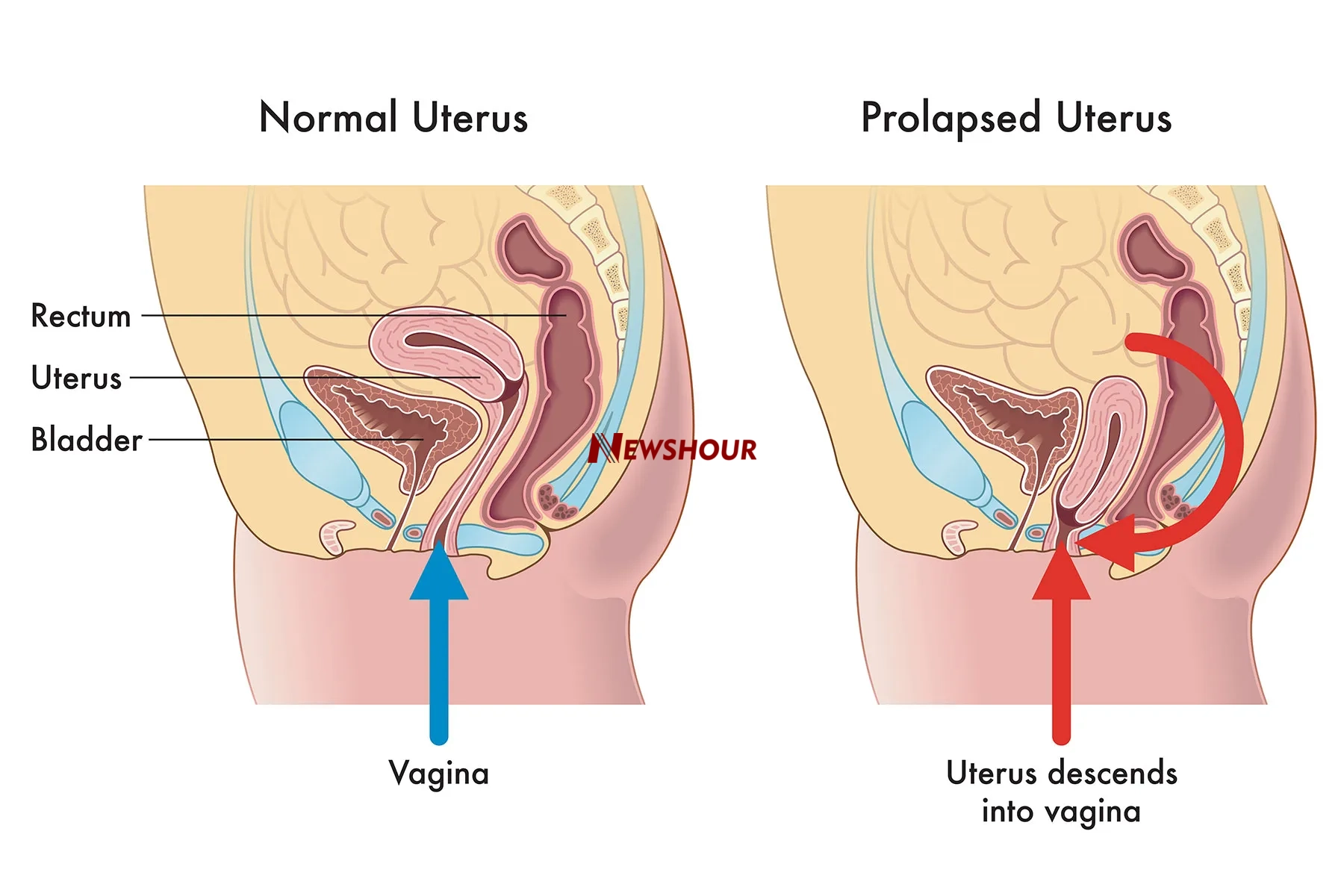 Your womb (uterus) is one of the most delicate and vital organs in your body. It plays a key role in...