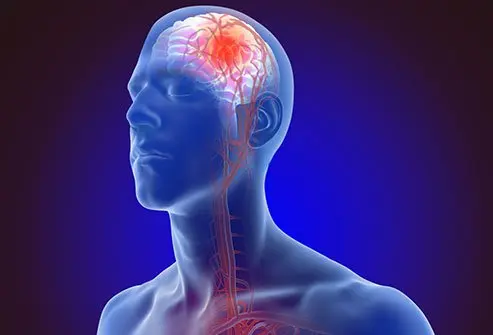 Stroke is a serious medical condition that can have devastating effects on a person’s life, especial...