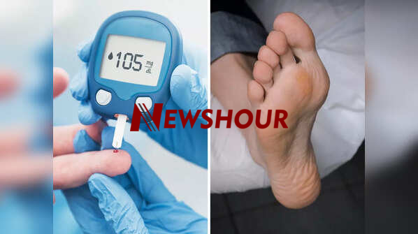 Type 2 diabetes is a chronic condition that affects how your body processes blood sugar (glucose), a...