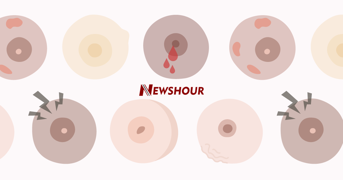 An instance of cancer that affects the breast tissue is breast cancer. It can afflict women of all a...