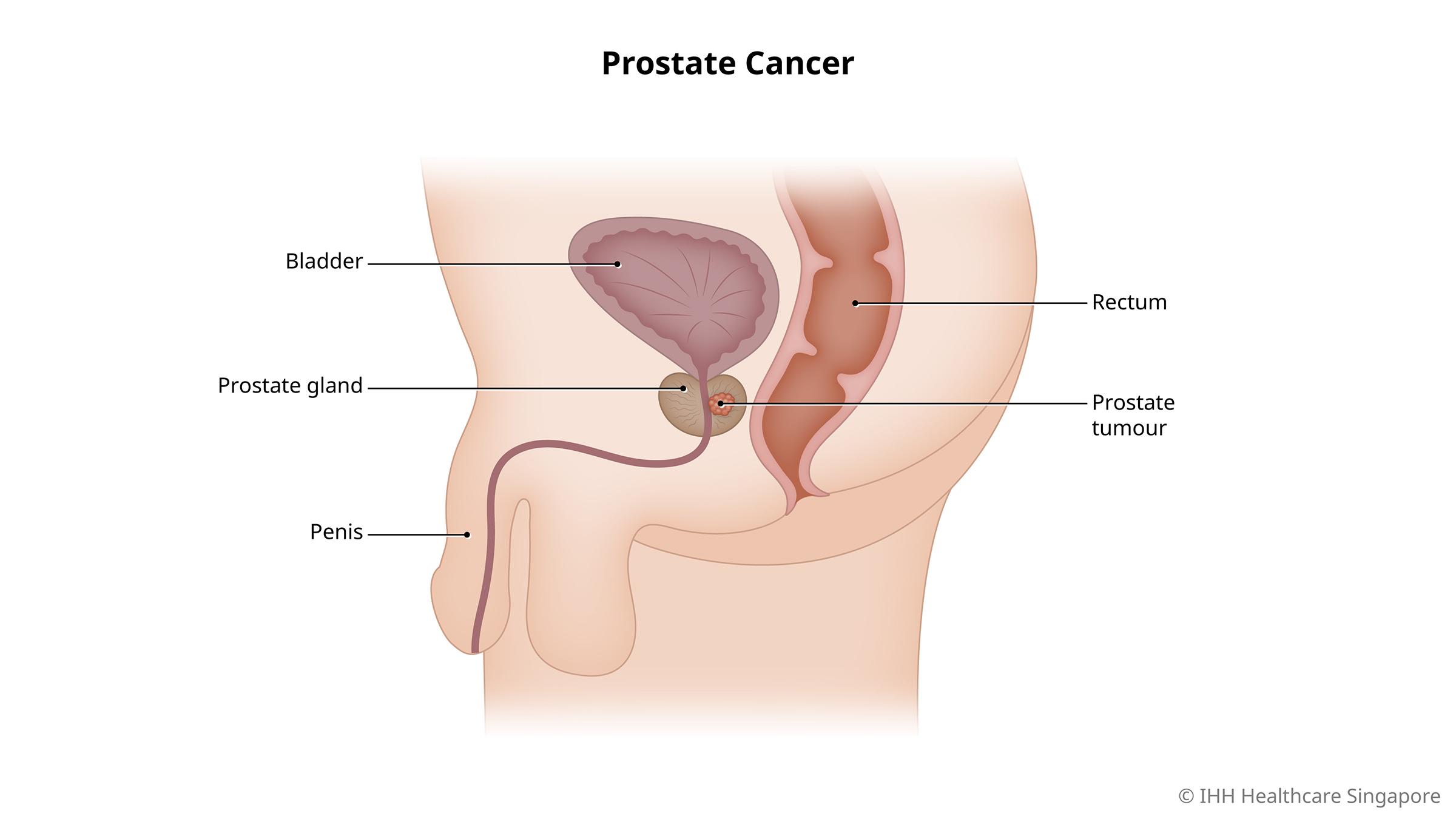 As men grow older, the risk of prostate enlargement increases. This condition, known as benign prost...