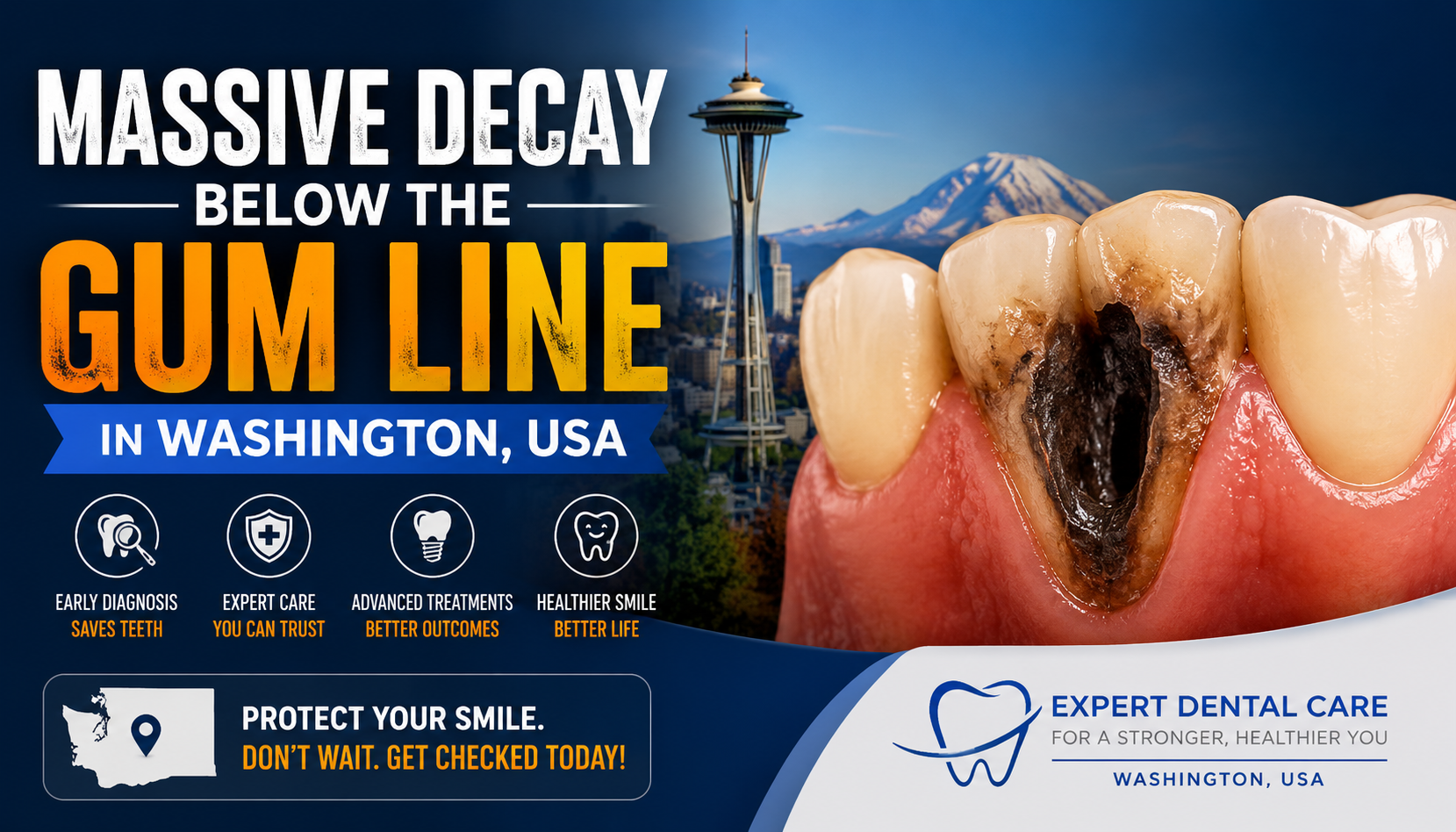 Language : EnglishTopics: Tooth decayFew dental problems create as much fear and uncertainty as disc...