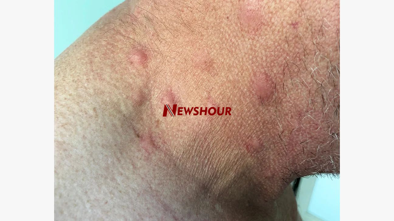 A rash is usually challenging to diagnose. Numerous things, such as a change in laundry detergent, a...