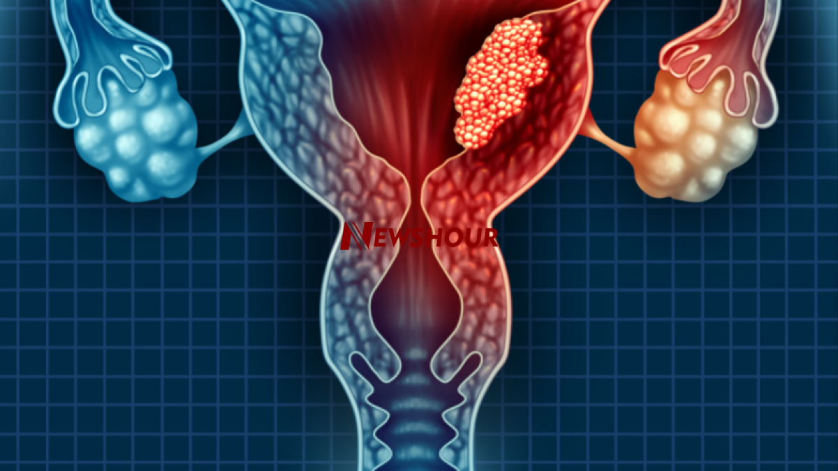 Uterine cancer, especially endometrial cancer (which affects the lining of the uterus), is becoming...