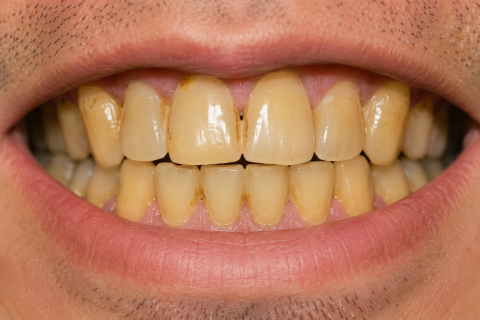 Image: Severity: ModerateTeeth Problems: Yellow teethThe True Culprits Behind Yellow Teeth: A USA De...