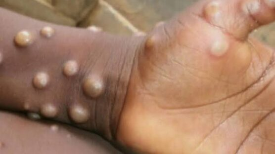 By Peter Duru
The Benue State Ministry of Health and Human Services has launched an investigation i...