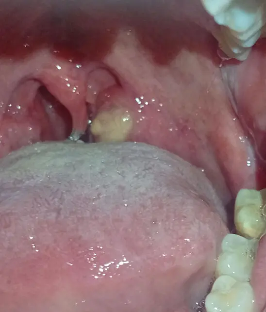 Image: Severity: CriticalTeeth Problems: Tonsil StoneI enlarged the uploaded image to 200% for visua...