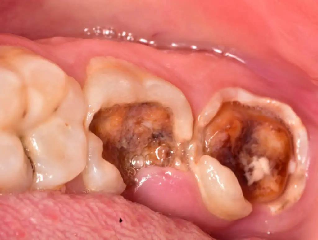 Image: Severity: SevereTeeth Problems: Broken toothYes — this is a serious-looking dental case, but...