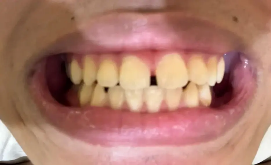 Image: Severity: SevereTeeth Problems: Braces irritationAlignment TeethI examined the photograph at...