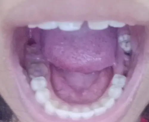 Image: Severity: CriticalTeeth Problems: Periodontal casesI enlarged the image and examined the visi...