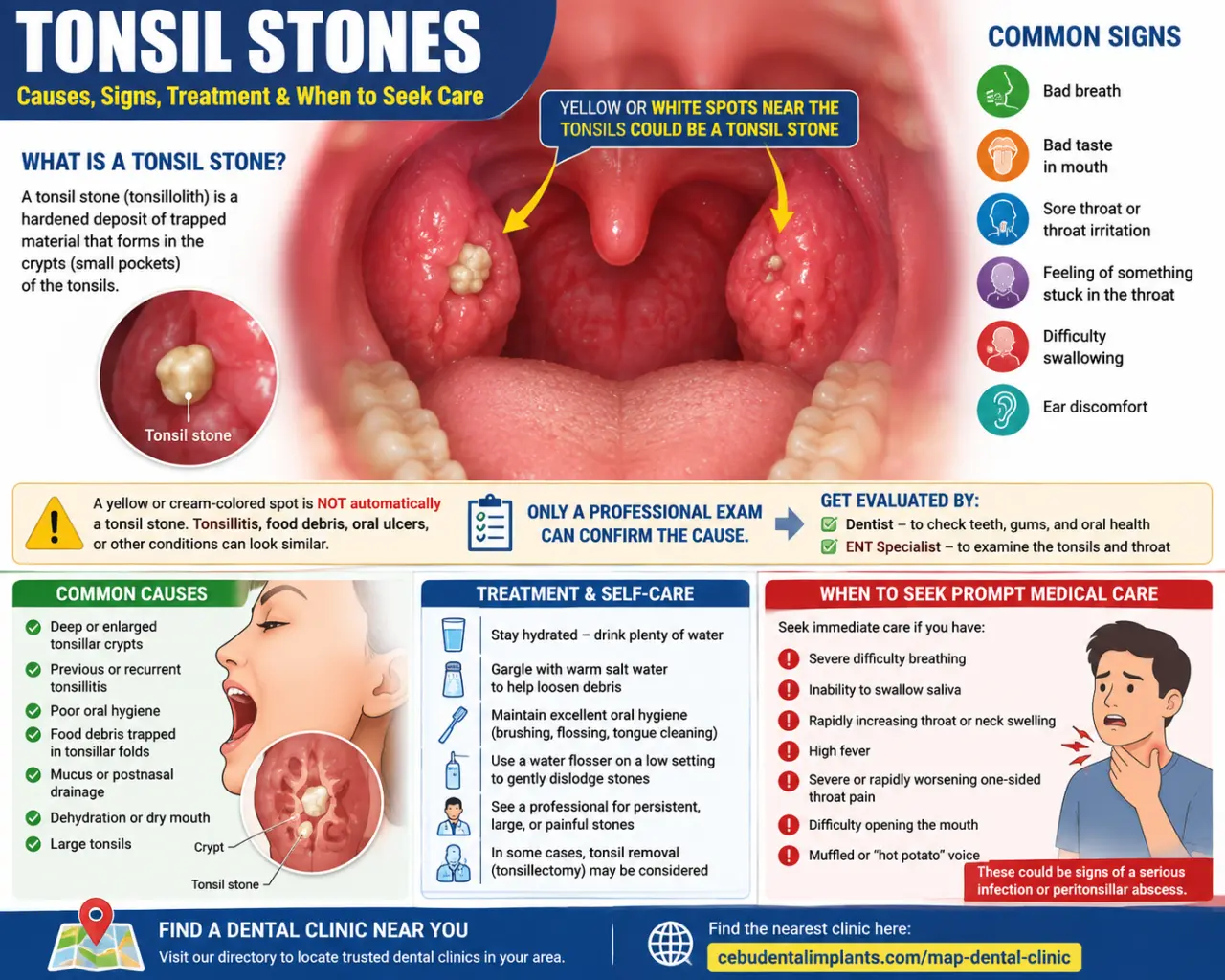 image hero: Country: United StatesTonsil Stones — Causes, Signs, Evaluation & When to Seek Care
A to...