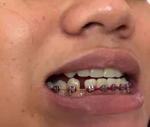 Image: Severity: MildTeeth Problems: Braces irritationGum infectionI examined the uploaded photo at...