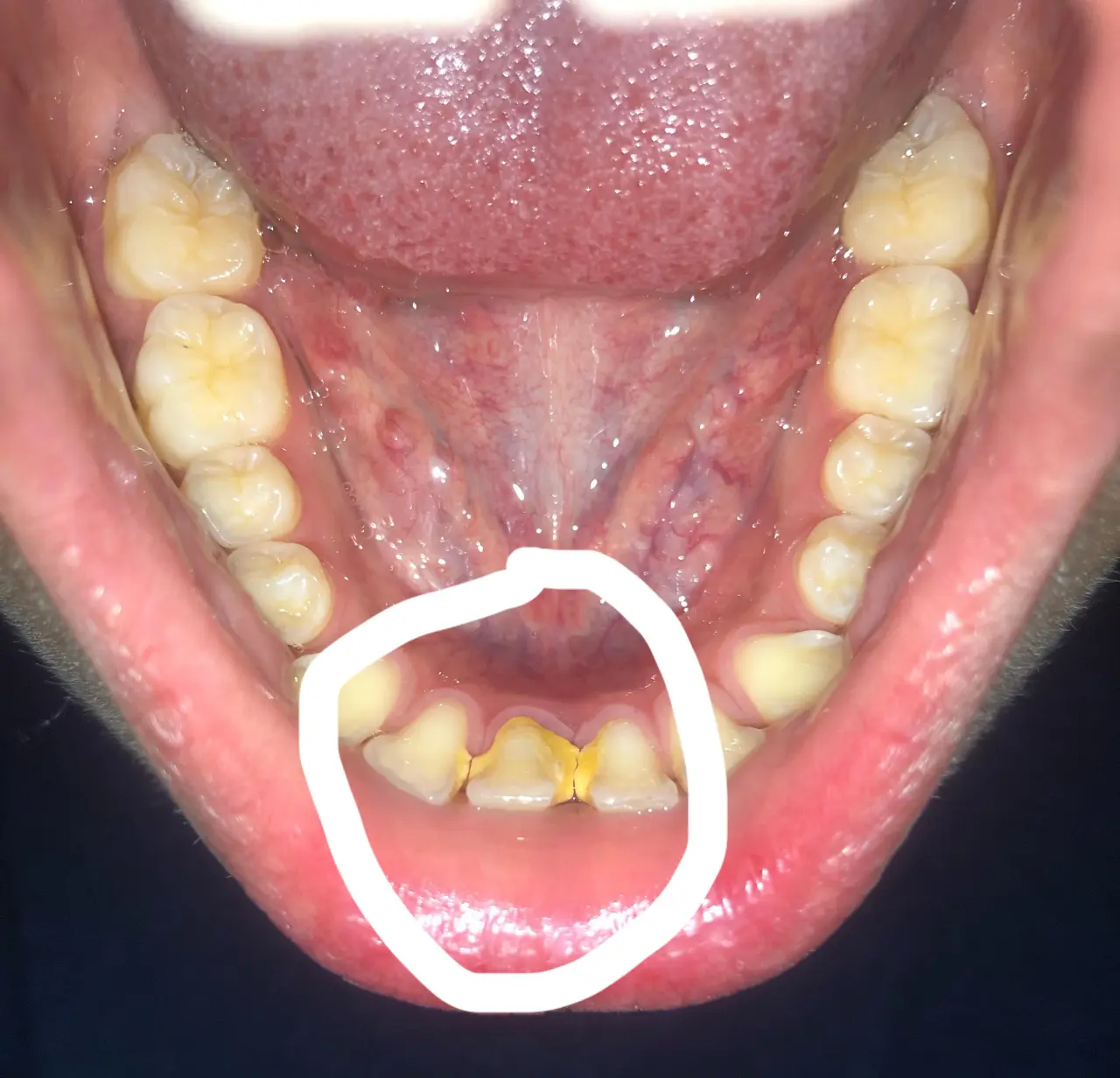Image: Severity: ModerateTeeth Problems: Calculus casesI examined the photograph at 100% resolution...