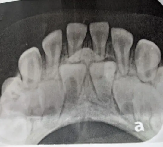 Image: Severity: CriticalTeeth Problems: Braces irritationGum infectionThe image appears to be an an...