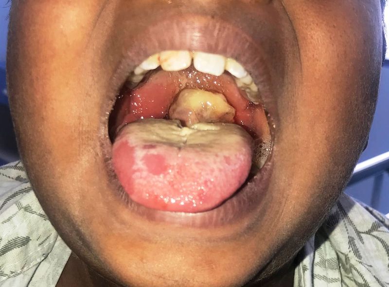 PAT ONUKWULI argues for surveillance and a catch-up vaccination in schools and communities An earlie...