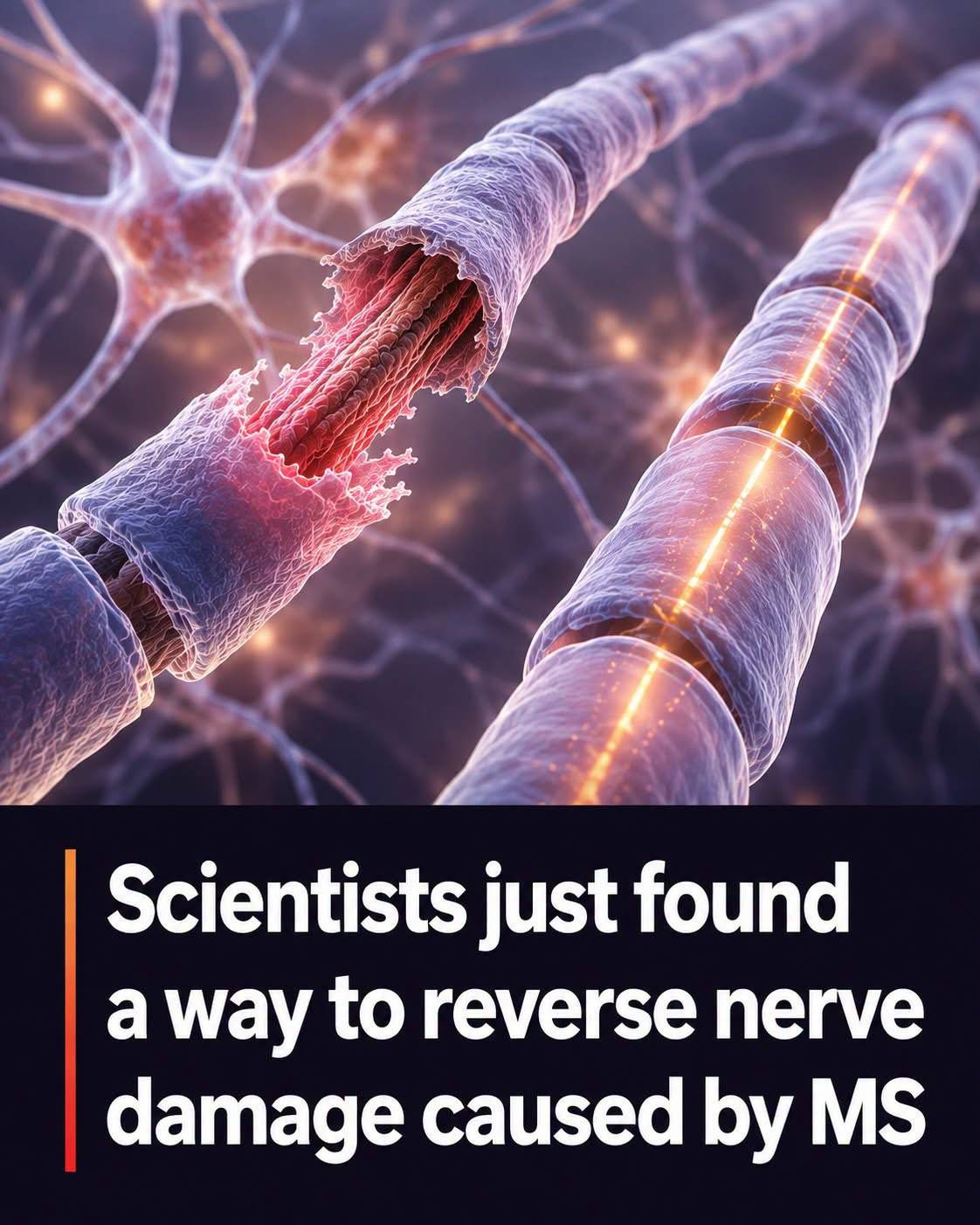 🚨 A Possible Breakthrough for Multiple Sclerosis
For decades, MS treatments have focused on slowin...