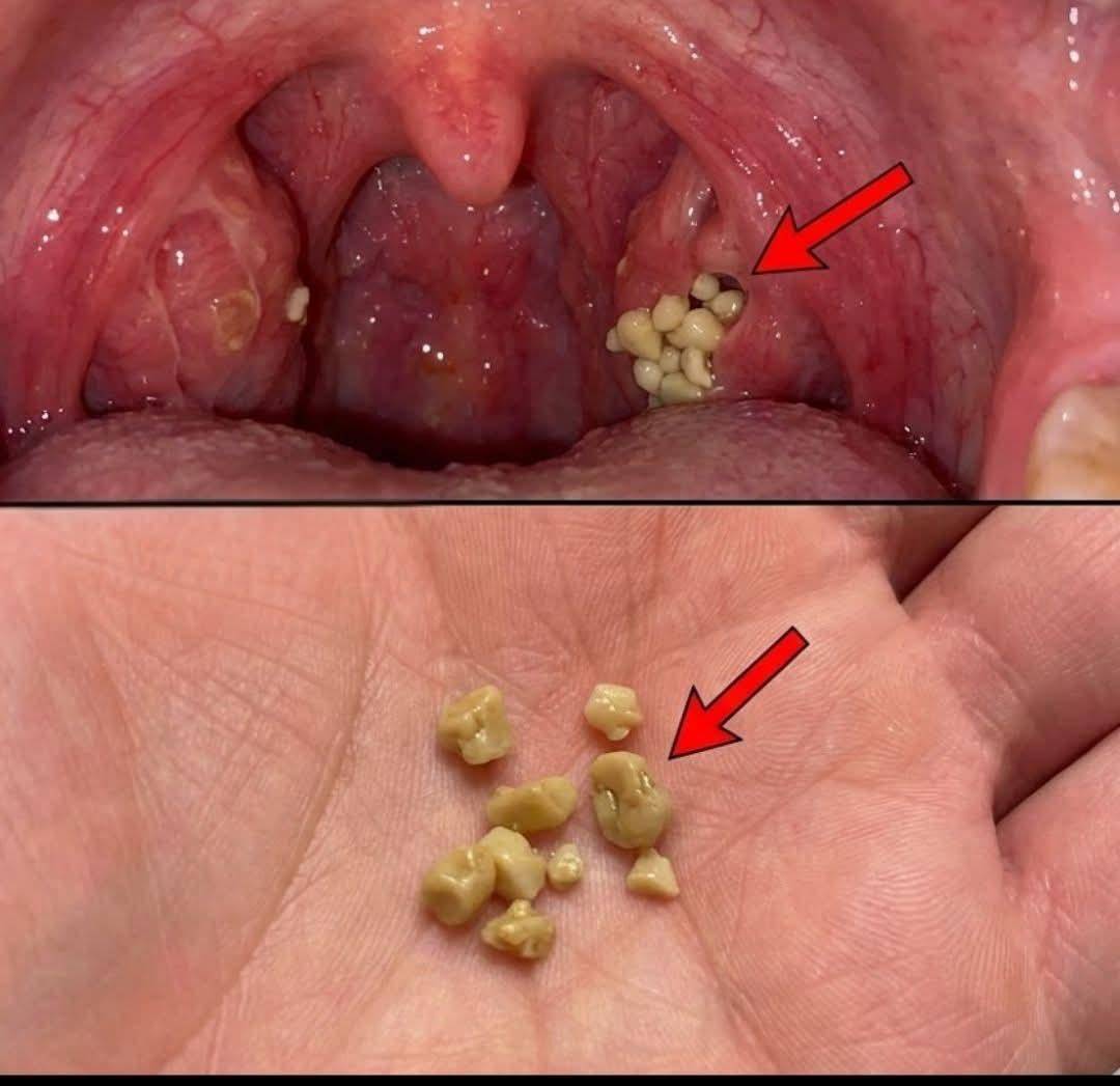 Most people think tonsils are useless, but they are actually an important part of your immune system...