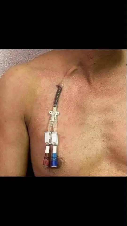 *_Did you know…?_*
Must read‼️‼️
Did you know that during dialysis, blood is removed from the body t...