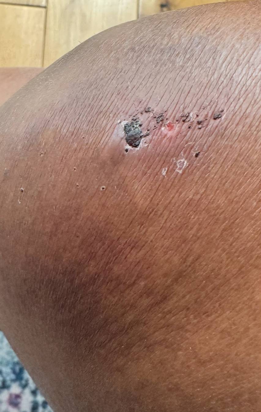 Exactly fifteen days today I had a very serious fall, I miss my steps but in all I want to thank God...