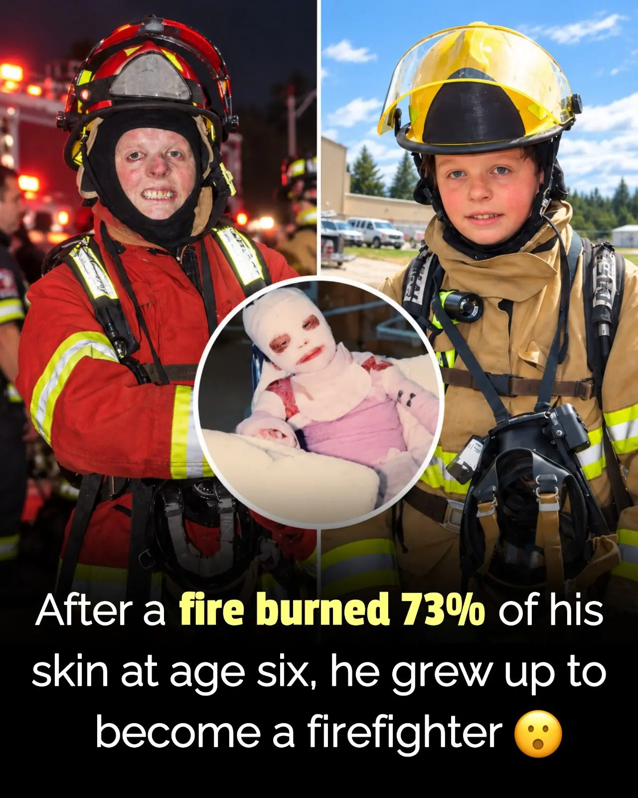 🔥 Burned 73%, Then Became Firefighter 🚒
