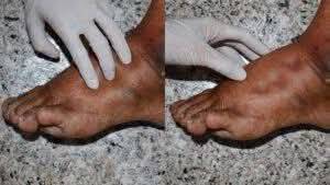 Severe Acute Malnutrition is increasing, especially under-5 children.
Kwashiorkor which is a type o...