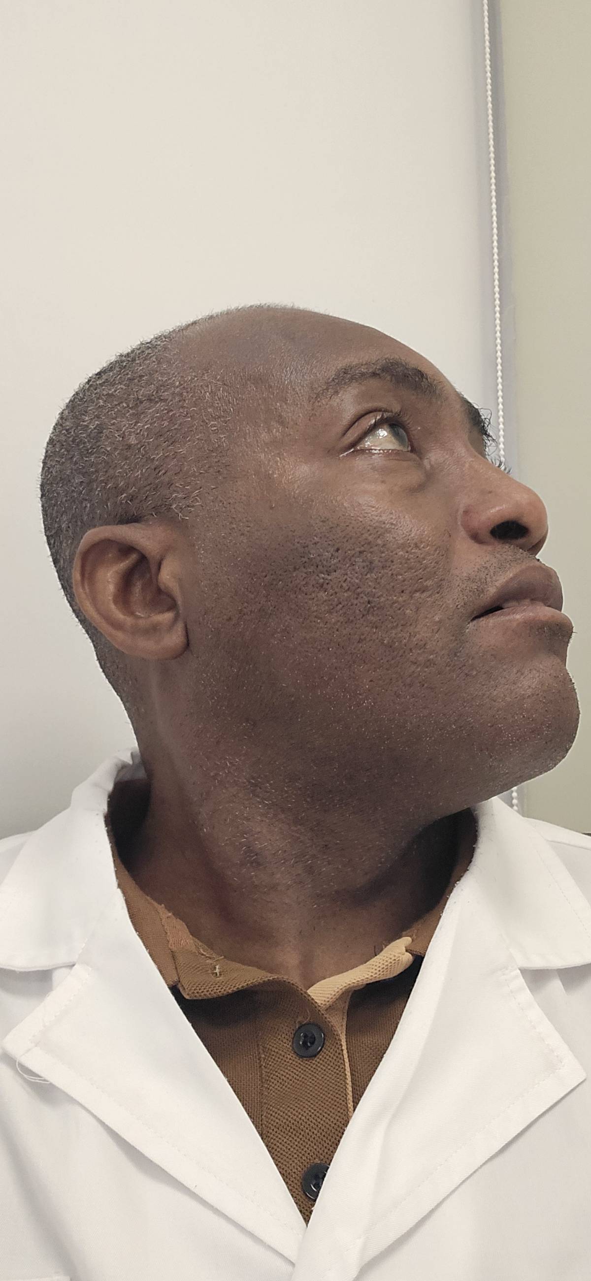 Sickle cell disorder causes trigeminal neuralgia.
Trigeminal neuralgia is a chronic neuropathic pain...