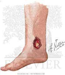 Sometimes, the pain of a chronic leg ulcer caused by sickle cell disorder can suddenly come like an...