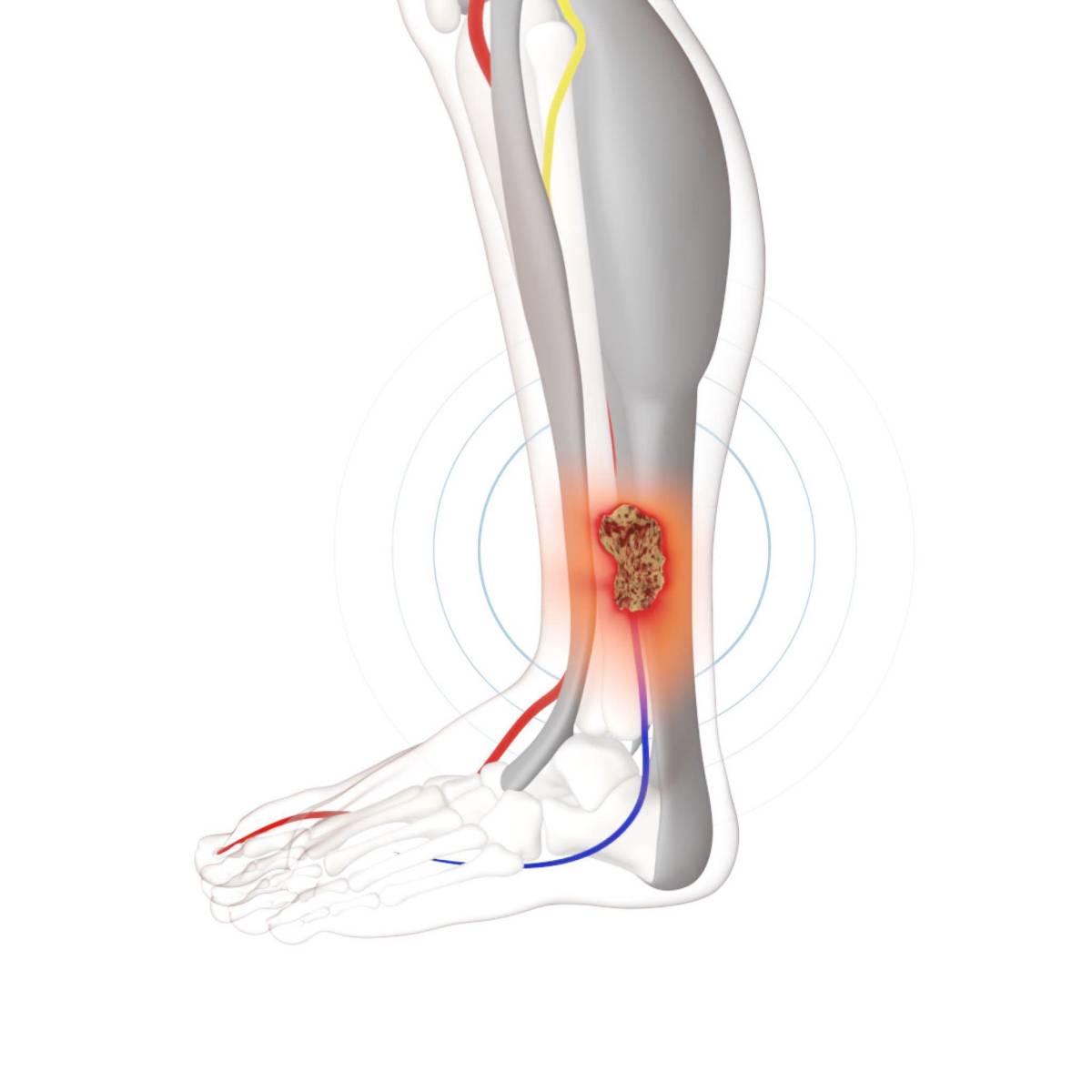 The pain of a chronic leg ulcer caused by sickle cell disorder can manifest in different ways.
Somet...