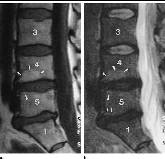 Sciatic pain aggravates on standing, walking, bending, straining and coughing . Other symptoms of lu...