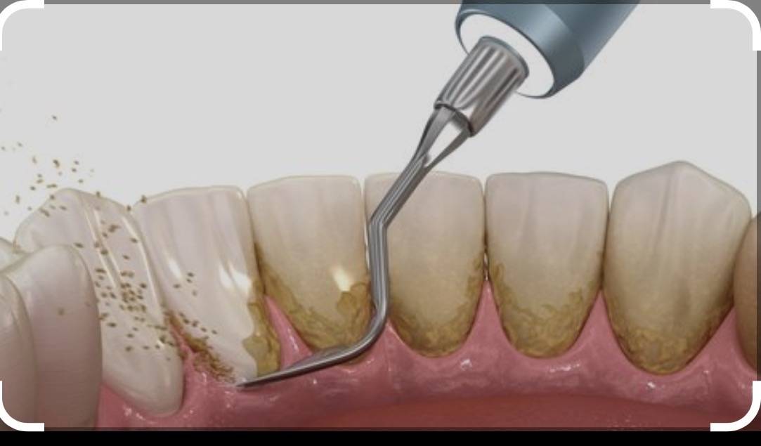 This image depicts a professional dental cleaning procedure known as scaling and Procedure
A dental...