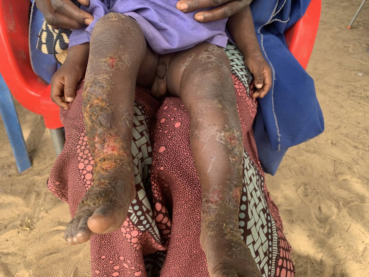 A 3year old child. Tell me the diagnosis of this skin condition.