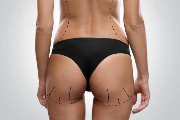 UK moves to ban BBL’s Brazilian Butt Lifts, over multiple health concerns and reports, as the market...