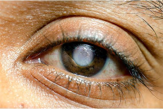 Abia Govt warns against quack eye doctors as glaucoma cases hit 6,381
What is glaucoma?
Glaucoma i...