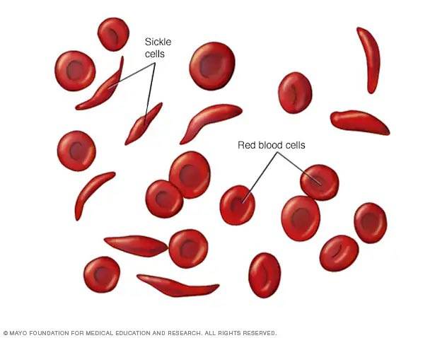Breaking: Cure for sickle cell disorder is now available at sickle cell foundation Nigeria, LUTH.
Th...