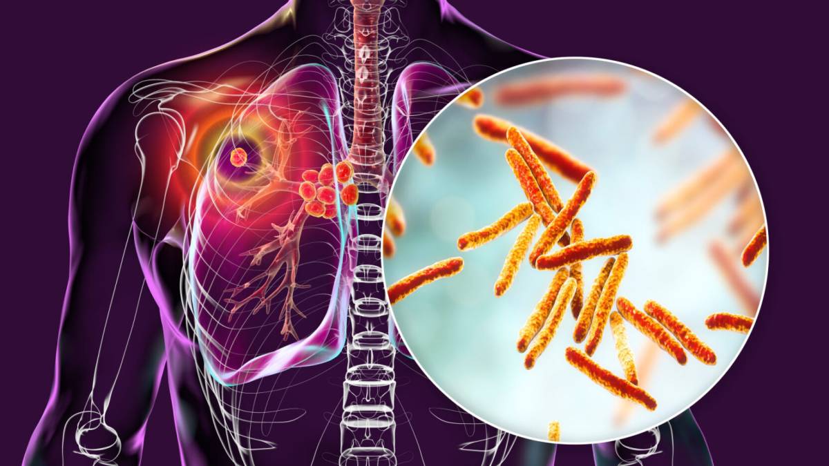 Tuberculosis (TB) is one of the world’s oldest infectious diseases and it is still a major public he...