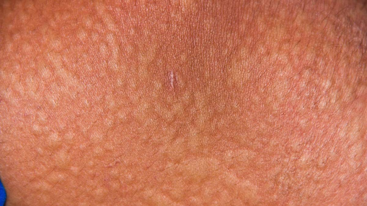 Measles is often mistaken as a “simple childhood illness,” but in reality, it is one of the most con...