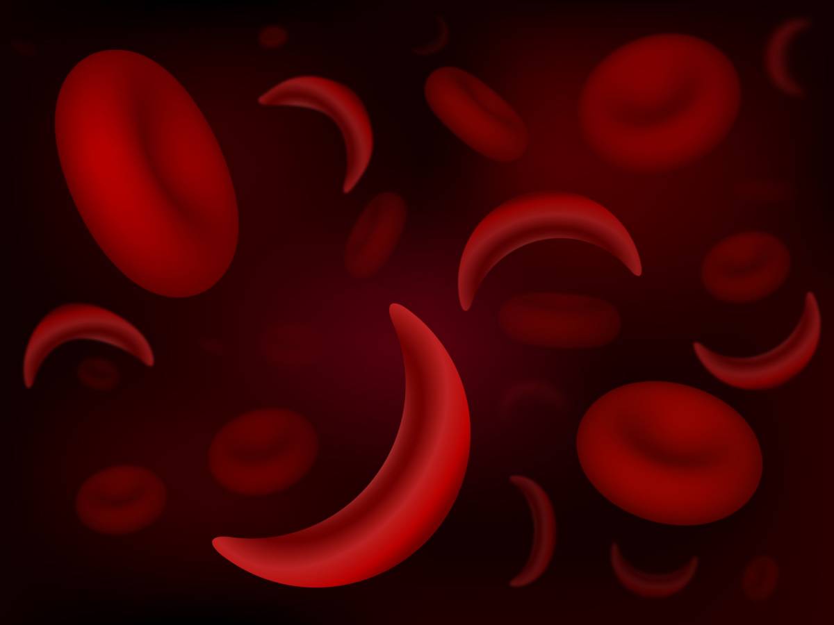 Sickle Cell Disease & the Importance of Genotype Testing
Sickle Cell Disease is a genetic blood dis...