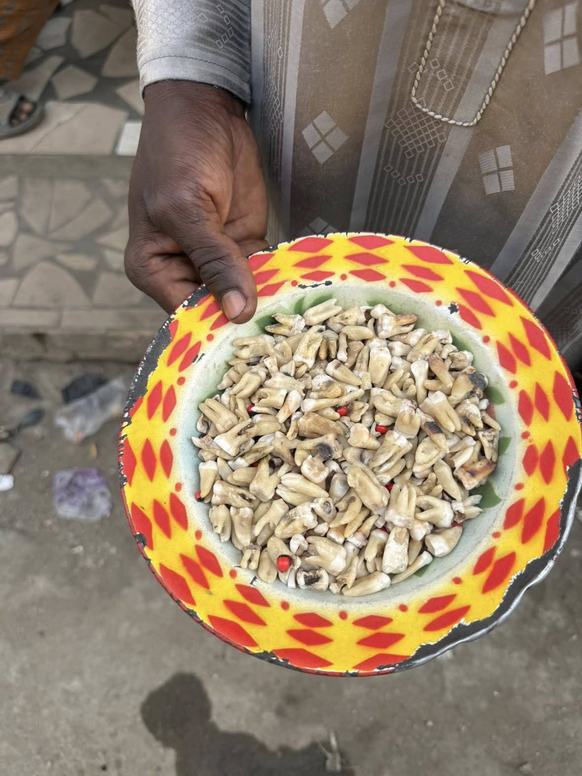 I found a dentist in a market in Nigeria. He’s not a licensed dentist… he’s a traditional one who pu...